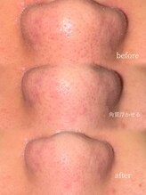 アクシア ビューティー サロン(AXSIA)/【毛穴洗浄＋モデリングパック】