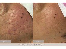 ミランジュ 新瑞橋(miranju)/ニキビ肌に◎ハーブピーリング