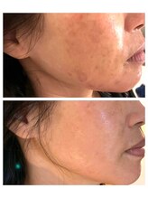 ユイ(YUI)/ハーブリプロ1回施術の効果◎