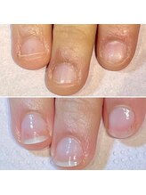 ココデネイル(cocode nail)/悩み：爪噛み（20代前半）その２