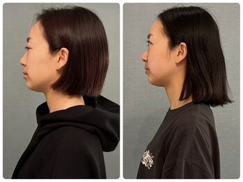 カナエルサロン 旭川(KANAERU SALON)/【小顔ケア】症例☆