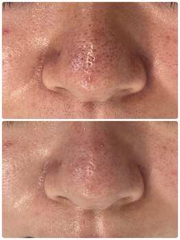 スムース(smooth)/ハイドロフェイシャル