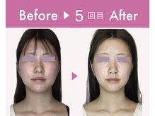 ビジュー(bijoux)/ララピールビフォアフ５回