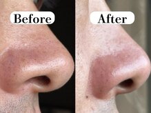 ビースキン 広島(BE:SKIN)/毛穴洗浄/ハーブピーリング