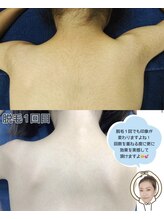 オーシャンブルー 長崎店(OCEAN BLUE)/症例　子ども脱毛　キッズ脱毛