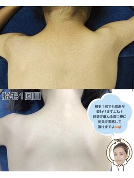 オーシャンブルー 長崎店(OCEAN BLUE)/症例 子ども脱毛 キッズ脱毛