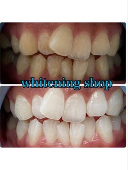 ホワイトニングショップ 鳥取店/ホワイトニングビフォーアフター