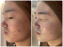 エスアール アミティ(SR Amity)/左Before／右After 