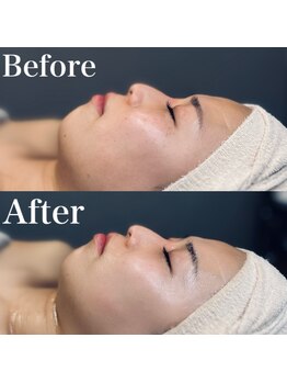 エクリア(ECLIA)/フェイシャル Before⇒After