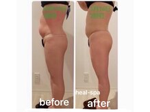 ヒール スパ(heal spa)/Before After