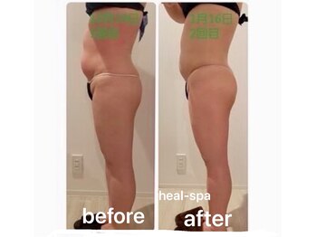 ヒール スパ(heal spa)/Before After