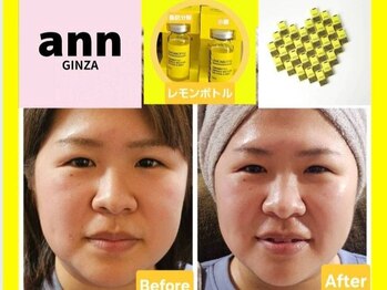 アン 銀座(ann)/レモンボトル 1回目