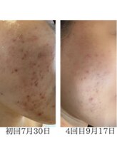 アウル 鳳店(OWL)/ニキビケア