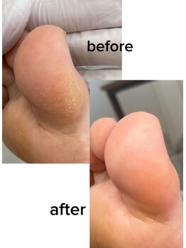 【魚の目/タコ】30代女性