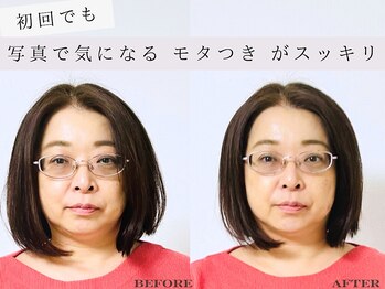 ミラ 長崎駅前店(MIRA)/小顔矯正_長崎_リフトアップ