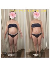 クリニカルエステ(Salon de LOMA reve beaute)/痩身ハイパーナイフ