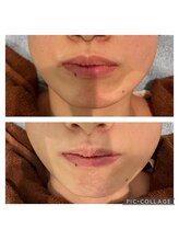 レイモード(Ray mode)/BBLフェイシャル