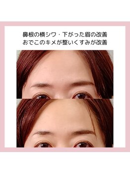 目元 口元のたるみ 眉間シワ改善専門サロン/おでこのツヤを出したい方向け