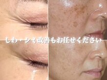 しわ・シミ・たるみなどのエイジングケアも得意です！