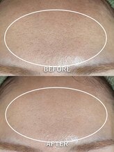 サロンドジェシカ(salon de Jessica)/プラズマ　美肌フォト