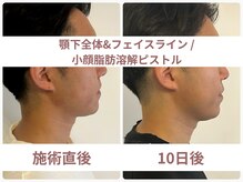 サボラミ(sabor A Mi)/小顔溶解ピストル　一回施術