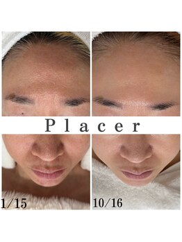 プラセル(Placer)/本気の肌質改善.9ヶ月の変化☆