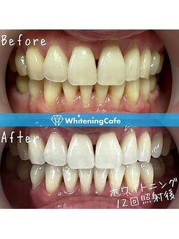 ホワイトニングカフェ 池袋東口店/ホワイトニングビフォーアフター