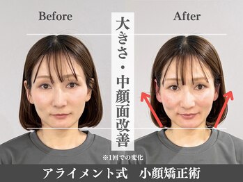 アライメントトウキョウ 表参道(Alignment TOKYO)/大きさ・中顔面改善