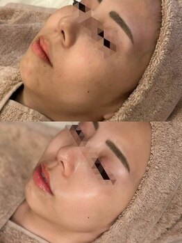 アマテラススキンラウンジ(Amatelas SKIN LOUNGE)の写真/◆Vリフト×LDMで叶える、リフトアップ&美ツヤ肌◆年齢を感じさせない美しさへ