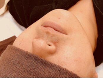 シュシュ(chou chou)/メンズ髭脱毛