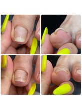 アンジュクレール(Ange Clair)/巻き爪矯正