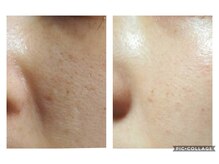 オアジスパ(Oasi Spa)/DTありハーブ３回