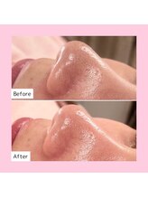 ホワイトラボ ライカム前店(White labo)/【施術例】毛穴洗浄ピーリング