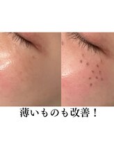 ブレリアントサロン 池袋店(brillant salon)/【施術】シミケア_施術後