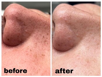 ベルマタン(belle matin)/毛穴、ここまで変わる