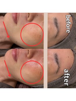 モーイエンチャーム(mooi en charme)/【ハリ・たるみ・シワ】顔のみ