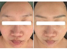 美時雨/ニキビにお悩みの方！