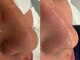 サイセイ(SAISEI)の写真/【メンズも毛穴ケアする時代!】SAISEI”独自”毛穴ハイドラ洗浄で汚れや埋毛ごっそり除去★毛穴洗浄¥6980