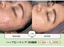 ベネミー 恵比寿(Benemi)の雰囲気（ハーブピーリング￥5,500でニキビケア、毛穴ケアができます。）