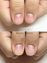 マリーロール 梅田店(Marie Laure)/自爪育成/深爪矯正/ネイルケア
