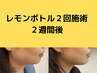 ◆大人気◆韓国発！レモンボトルで脂肪を分解してすっきり小顔◎1cc¥12500→