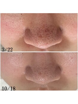 プラセル(Placer)/変わらなかった毛穴が少しずつ2