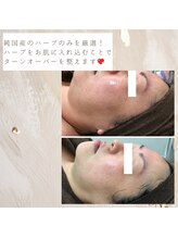 エイプリル/REVIVEハーブピーリング比較写真