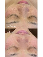 エレニア(Elenear)/お顔脱毛の効果