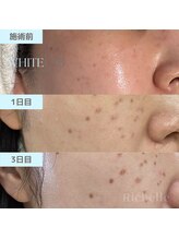 リシェル(Richelle)/【WHITELAB☆はがれるシミケア】