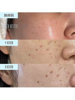 リシェル(Richelle)/【WHITELAB☆はがれるシミケア】
