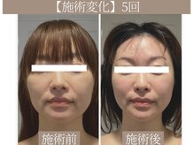 ドクターボディ 恵比寿店(Dr.Body)/【フェイスラインのたるみ】