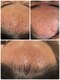 ビューティーアート イツモ(Beauty art ITSUMO)の写真/長年のお肌の悩みに。どこに行っても改善しない/どこに行けば良いか迷ってしまっている方必見！肌質改善◎