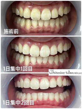 ホワイトニングサロン 京都烏丸店/ホワイトニング施術例