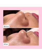 ホワイトラボ ライカム前店(White labo)/【施術例】毛穴洗浄ピーリング